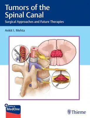Tumors of the Spinal Canal: Surgical Approaches and Future Therapies