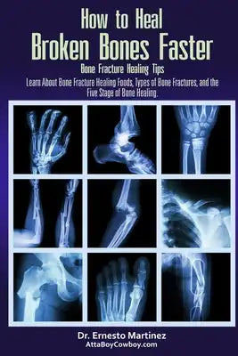 How to Heal Broken Bones Faster. Bone Fracture Healing Tips: Learn About Bone Fracture Healing Foods, Types of Bone Fractures, and the Five Stages of